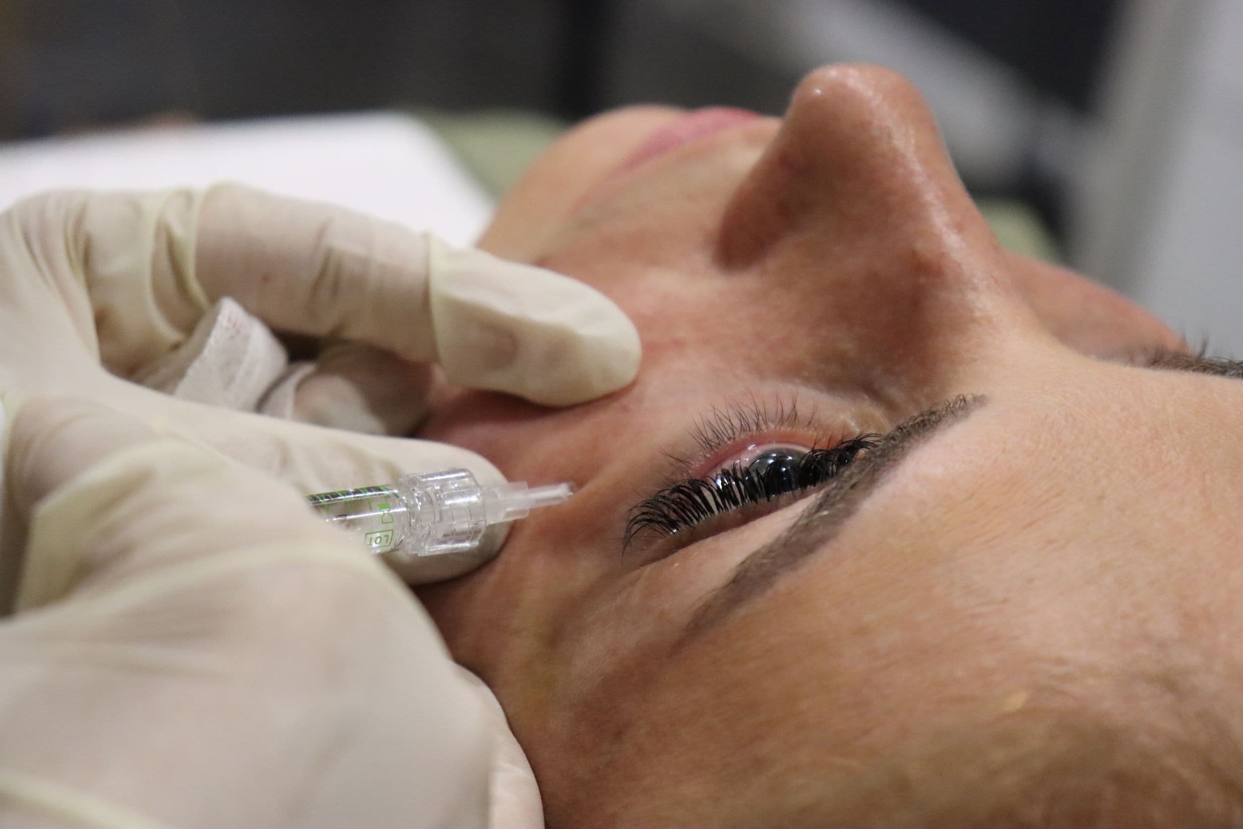 انواع فیلرها و مزایای آنها